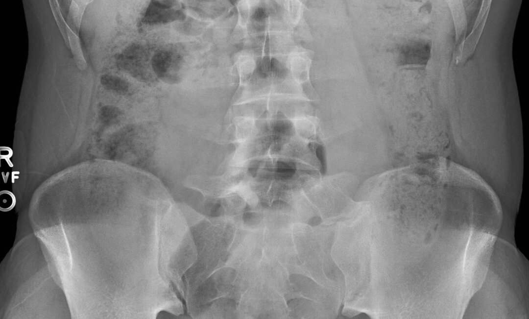 An undated U.S. National Library of Medicine X-Ray photo shows a sigmoid adenocarcinoma, a type of colorectal cancer. (US National Library of Medicine)