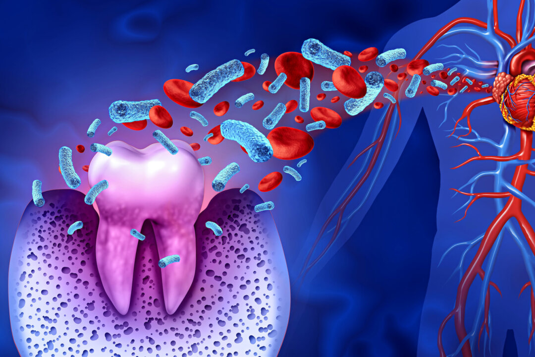 Can a Dental Infection Cause a Massive Heart Attack?