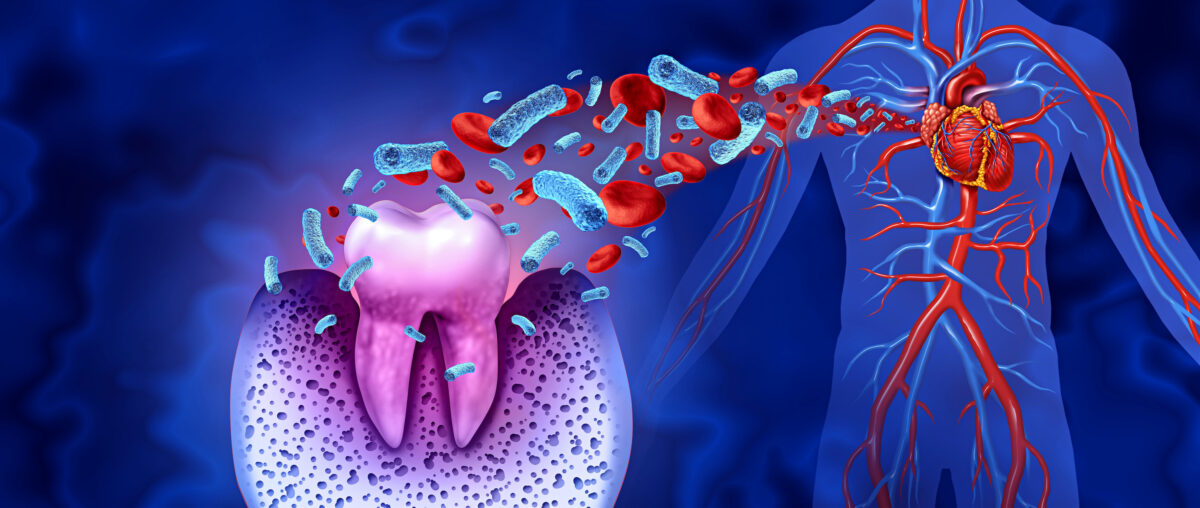 NextImg:Can a Dental Infection Cause a Massive Heart Attack?