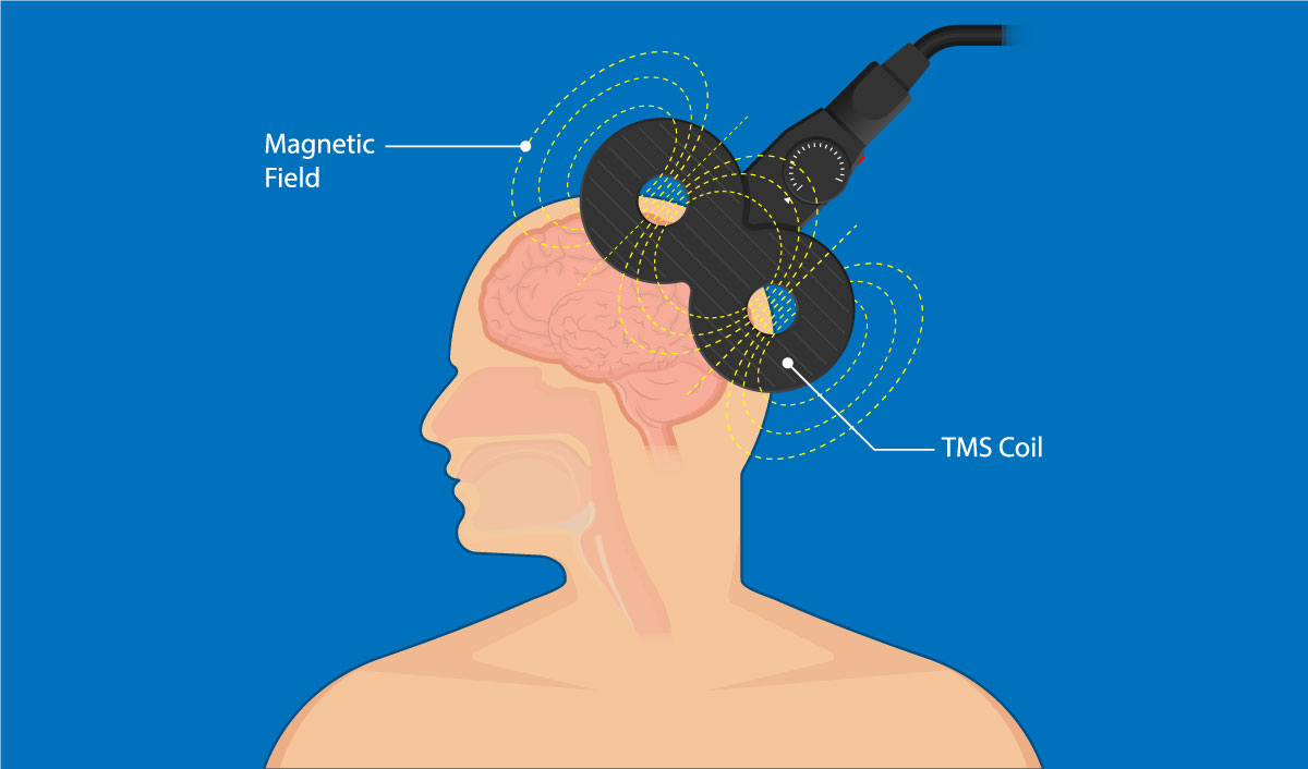 Transcranial magnetic stimulation (TMS) treatment. 