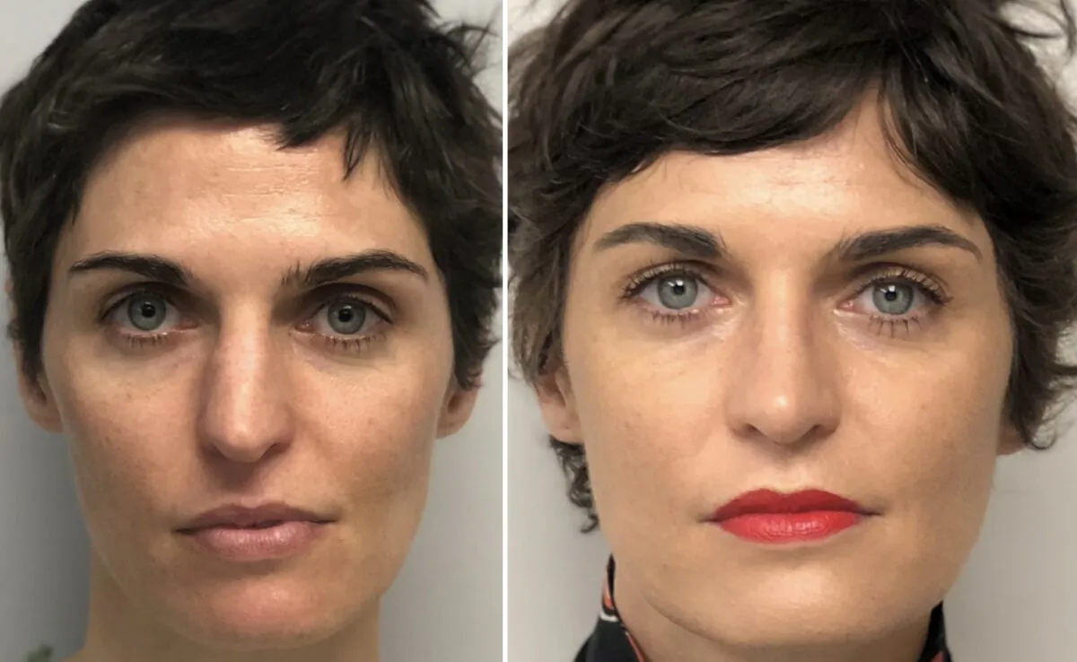 A rhinoplasty patient of Dr. Oscar Trujillo. (Courtesy of Trujillo Facial Plastics)
