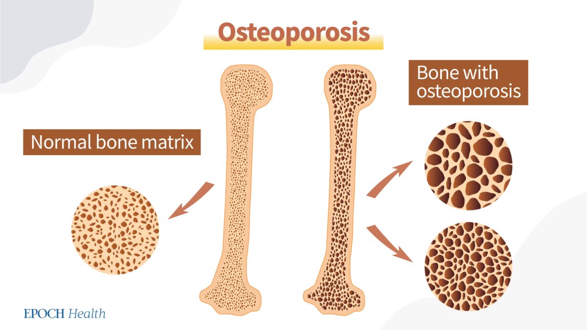 Bone loss and osteoporosis are problems that both men and women will face as they age. (The Epoch Times)