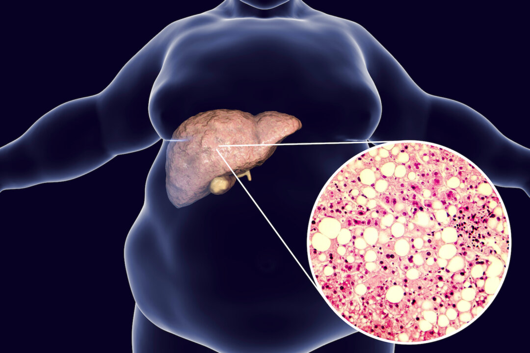 Nonalcoholic fatty liver disease may be represented by an increase in one bacteria, in a similar way the microbiome is a biomarker for obesity and end-stage liver fibrosis. (Shutterstock)