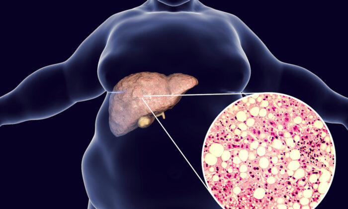 Study: Diet High in Sugar and Fat Produces Bacterium That Triggers Fatty Liver Disease