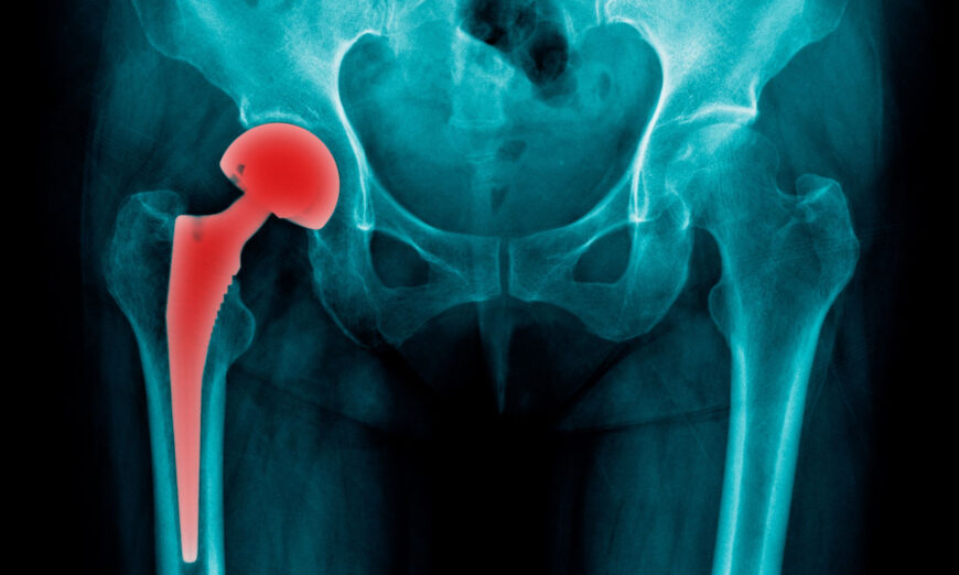 Alzheimer’s-Like Symptoms After Hip Replacement May Be From Cobalt Poisoning