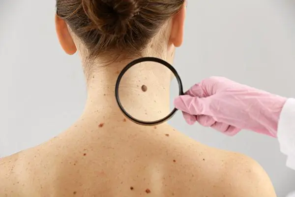President Biden Has Cancerous Lesions Removed, 5 Warning Signs of Skin Cancer