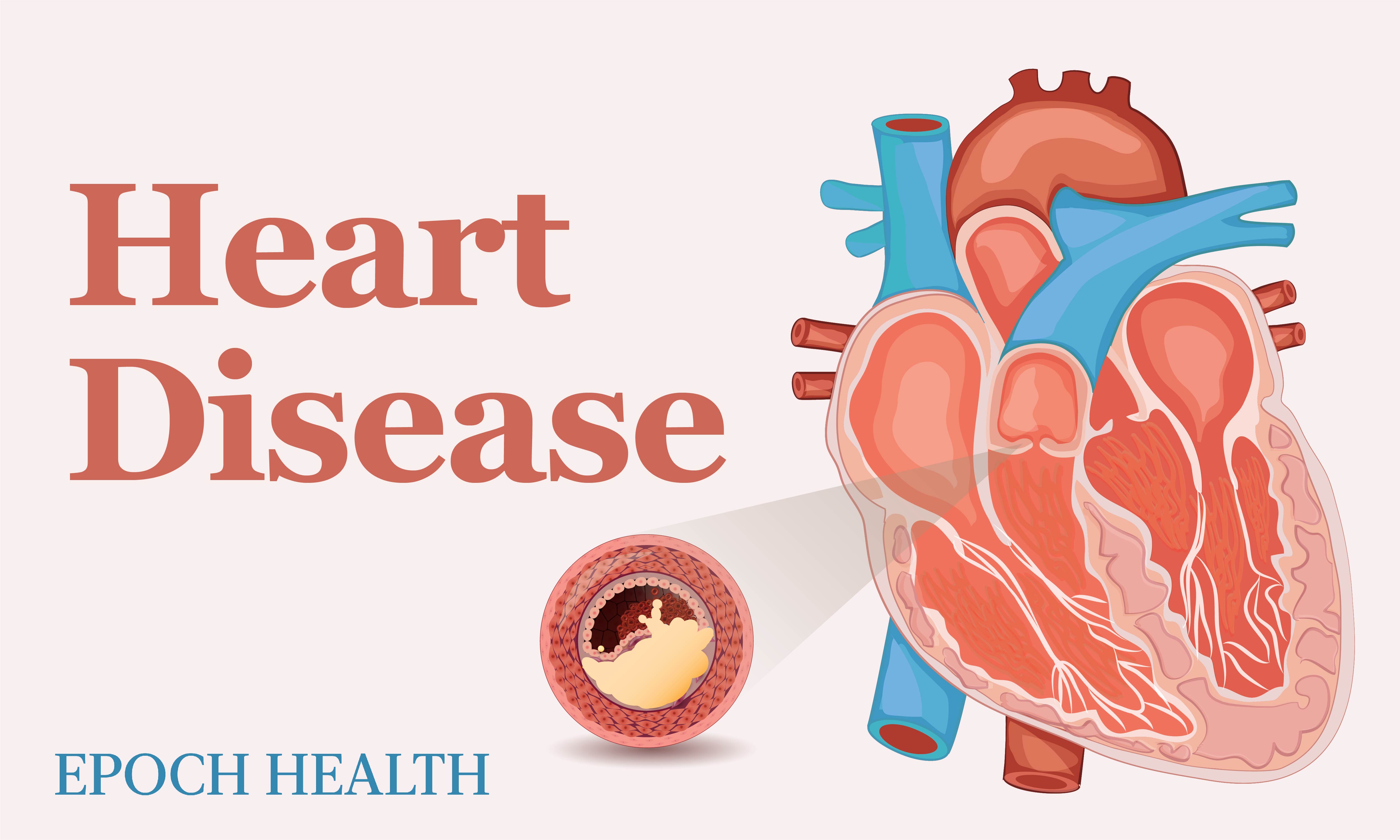The Essential Guide to Heart Disease: Symptoms, Causes, Treatments, and Other Remedies - Vimarsana News