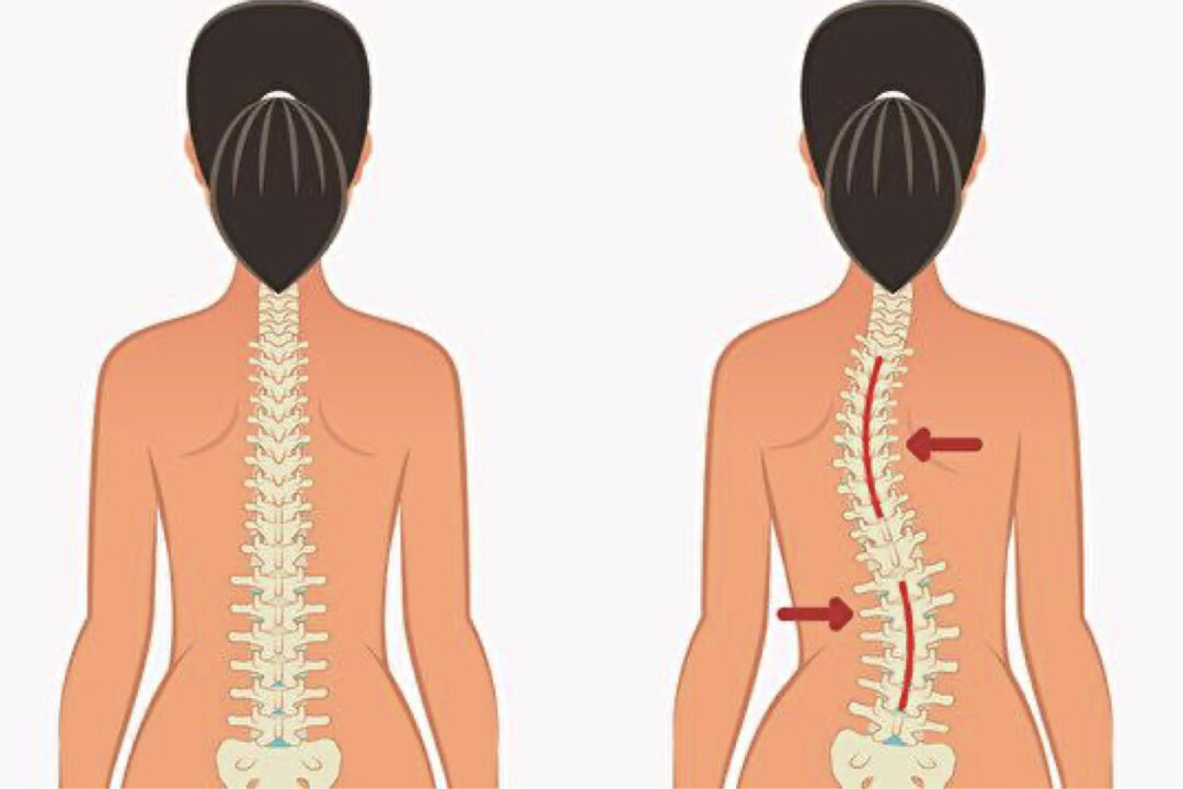 Improper posture can easily cause scoliosis. How to adjust? (Shutterstock)