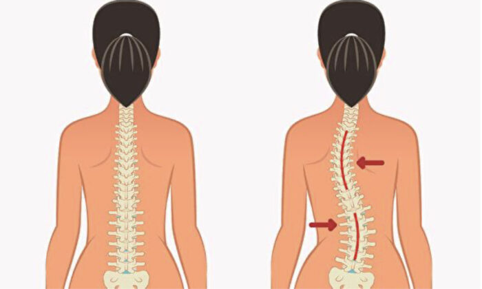 3 Simple Moves to Improve Spinal Health and Correct Scoliosis