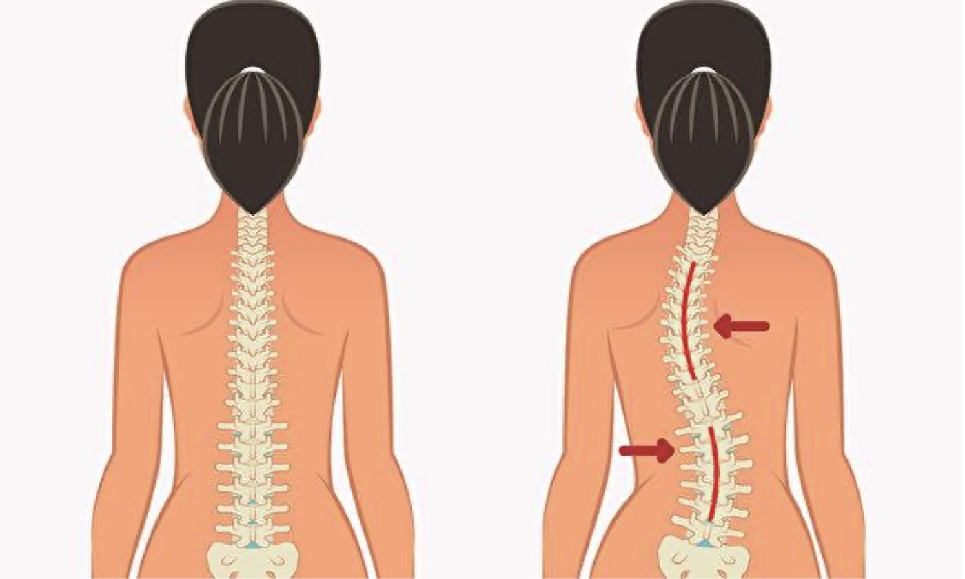 3 Simple Moves to Improve Spinal Health and Correct Scoliosis - Vimarsana News
