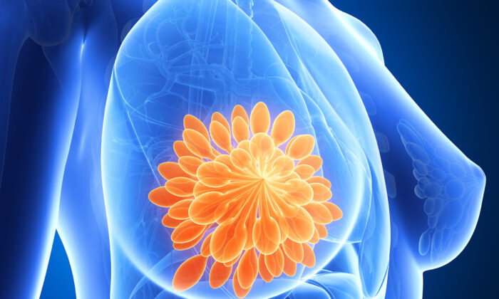 Breast Cancer: High-Risk Groups, Behaviors and 6 Acupoints That Promote Cancer Prevention