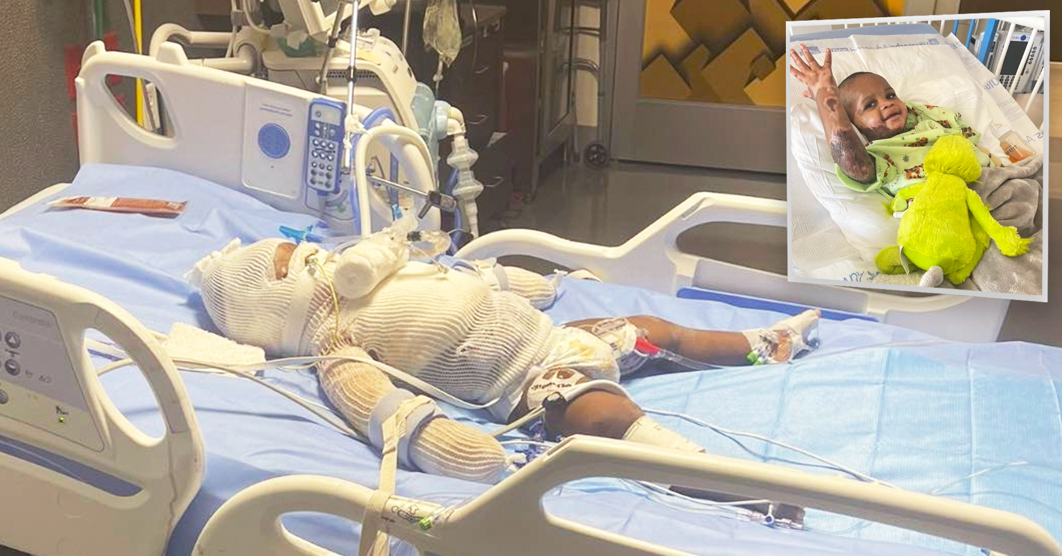 NextImg:Baby severely burned in candle explosion defies the odds, proves nothing can dim his smile