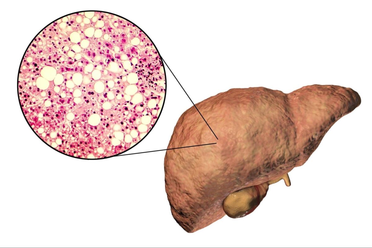 NextImg:Fatty Liver Increases Risk of Liver Cancer–Tips for Early Detection and Prevention