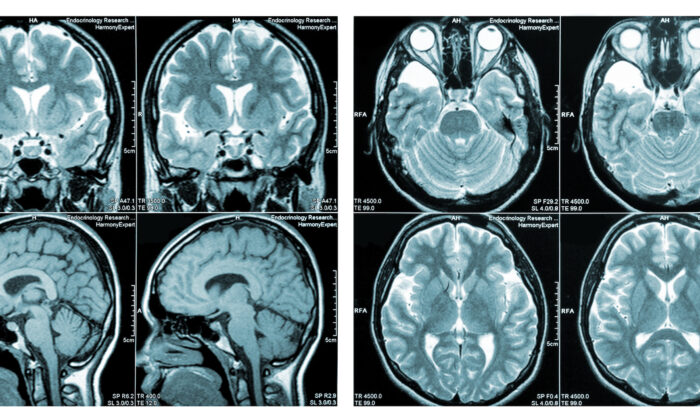 New Brain Injuries Connected to COVID Vaccines