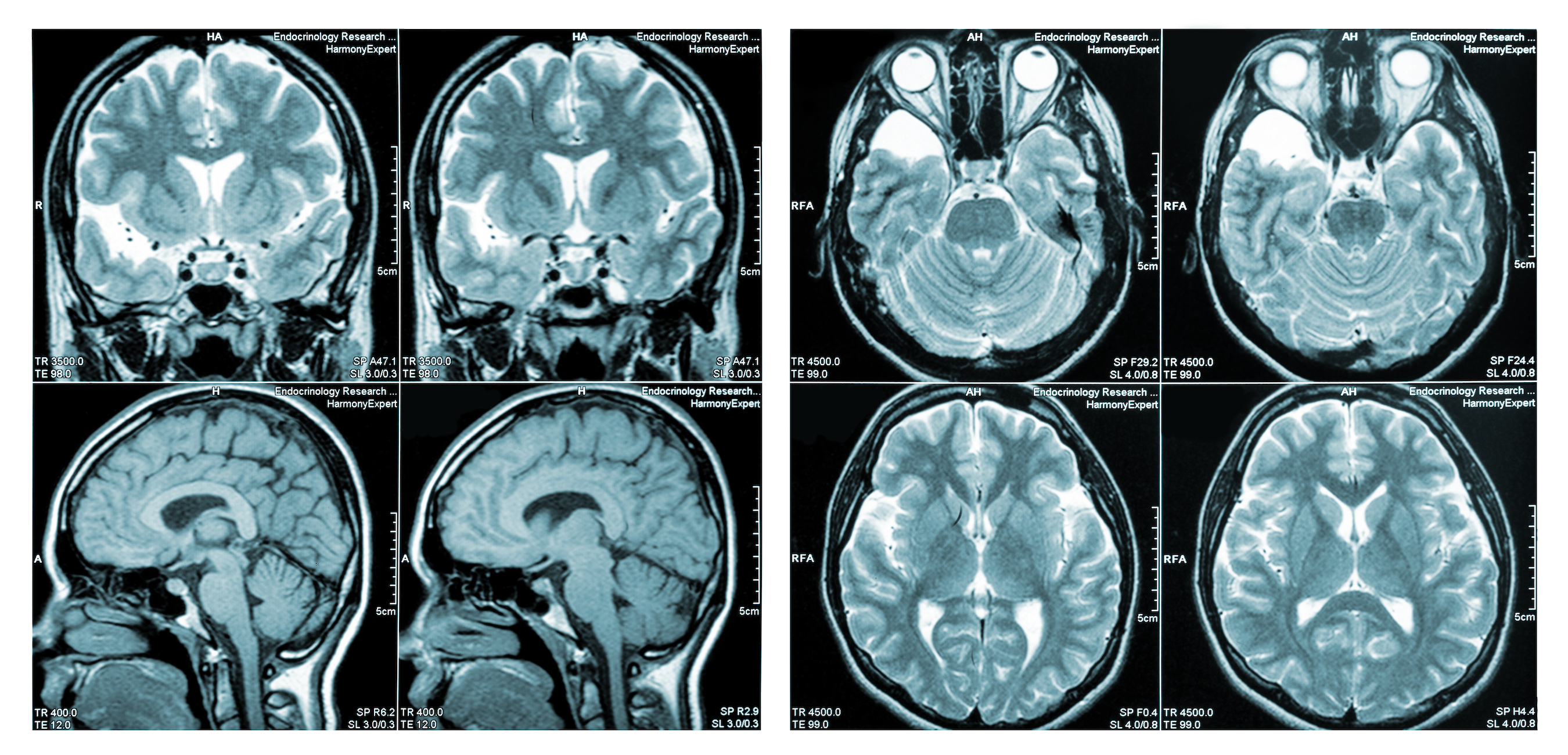 Brain Injuries After COVID Vaccination - Vimarsana News