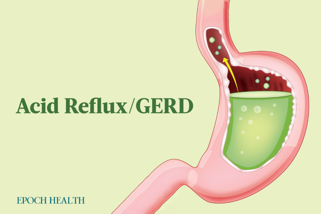 Anyone can experience acid reflux at times, but GERD occurs when acid reflux is chronic. (The Epoch Times)