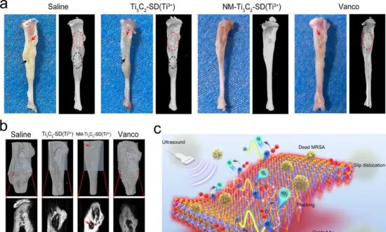 HKU Invents Antibacterial Nano-Sheet Treatment for MRSA Bone Marrow Infection With 99.72 Percent Effectiveness