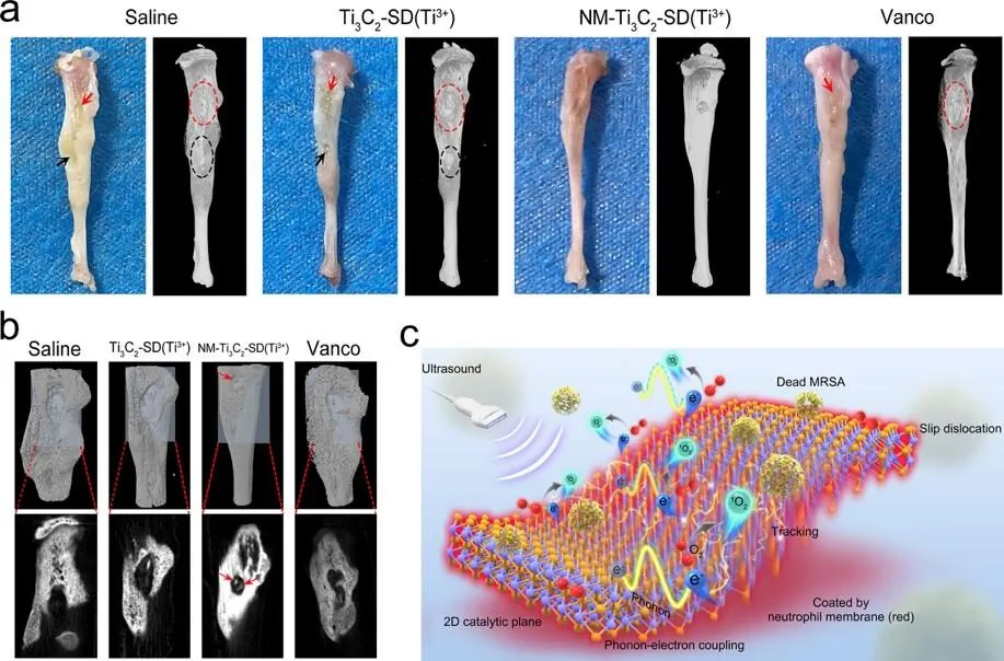 The University of Hong Kong School of Medicine has developed a two-dimensional sensitizer nano-sheet that can eliminate MRSA bone marrow infection. (Courtesy of University of Hong Kong)
