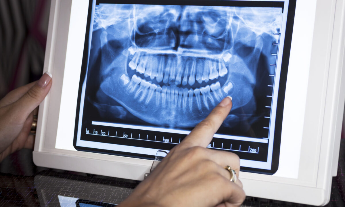 Dentists: Unexplained Pain, Tooth Loss and Bone Problems May Be Linked to COVID-19 Vaccine - Vimarsana News