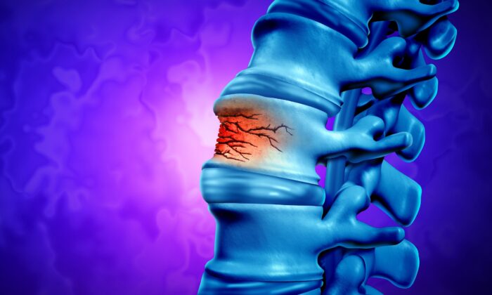 Vitamin C Deficiency Accelerates Bone Loss