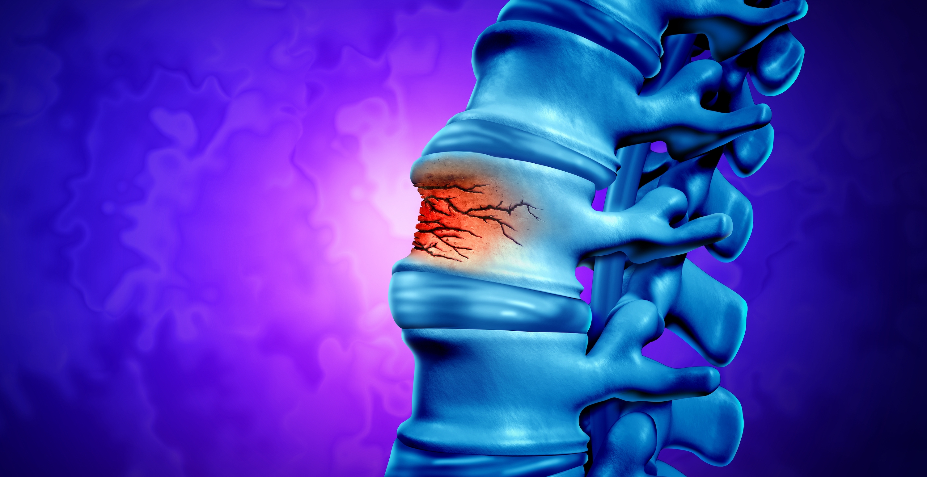 Vitamin C Deficiency Accelerates Bone Loss - Vimarsana News