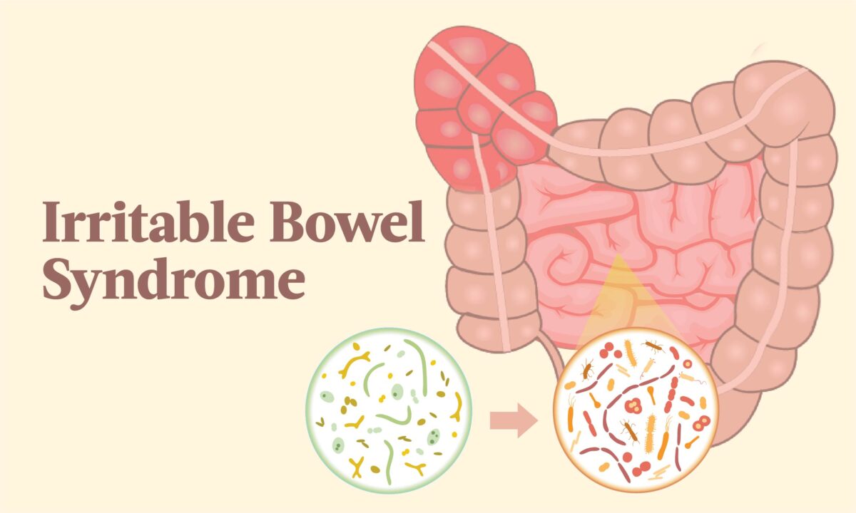 NextImg:Irritable Bowel Syndrome (IBS): Symptoms, Causes, Treatments, and Natural Remedies