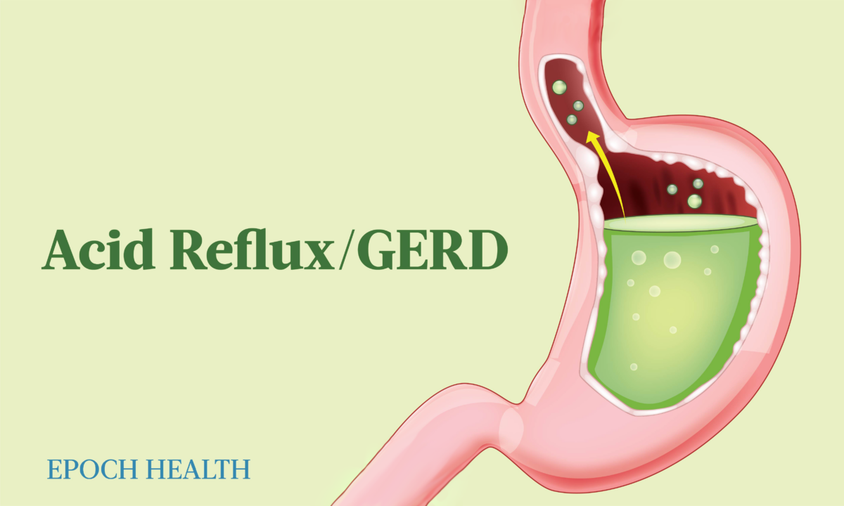 The Essential Guide to Acid Reflux and GERD: Symptoms, Causes, Treatments, and Natural Remedies