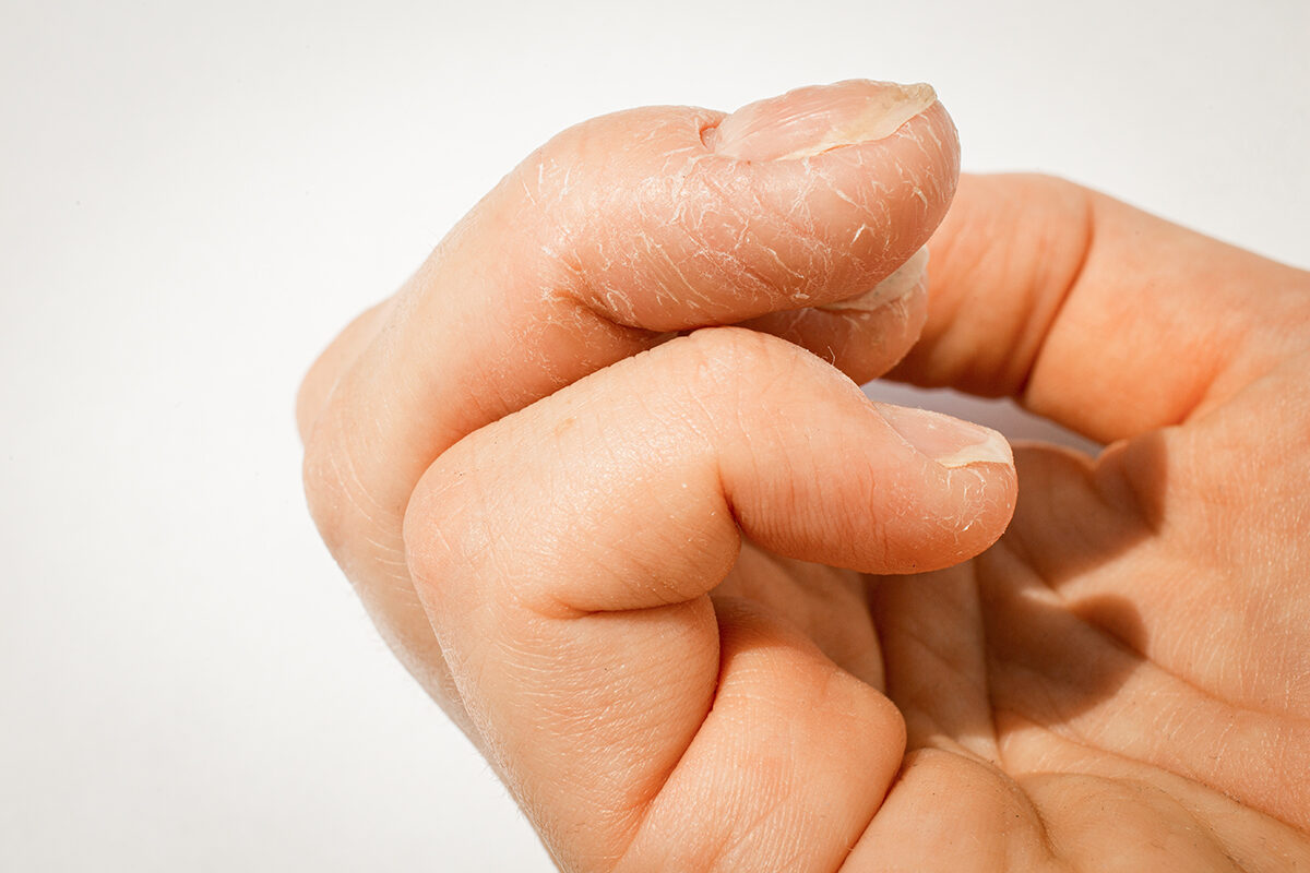 NextImg:Common Nail Conditions May Indicate You’ve Had COVID, Here's How to Keep Nails Healthy