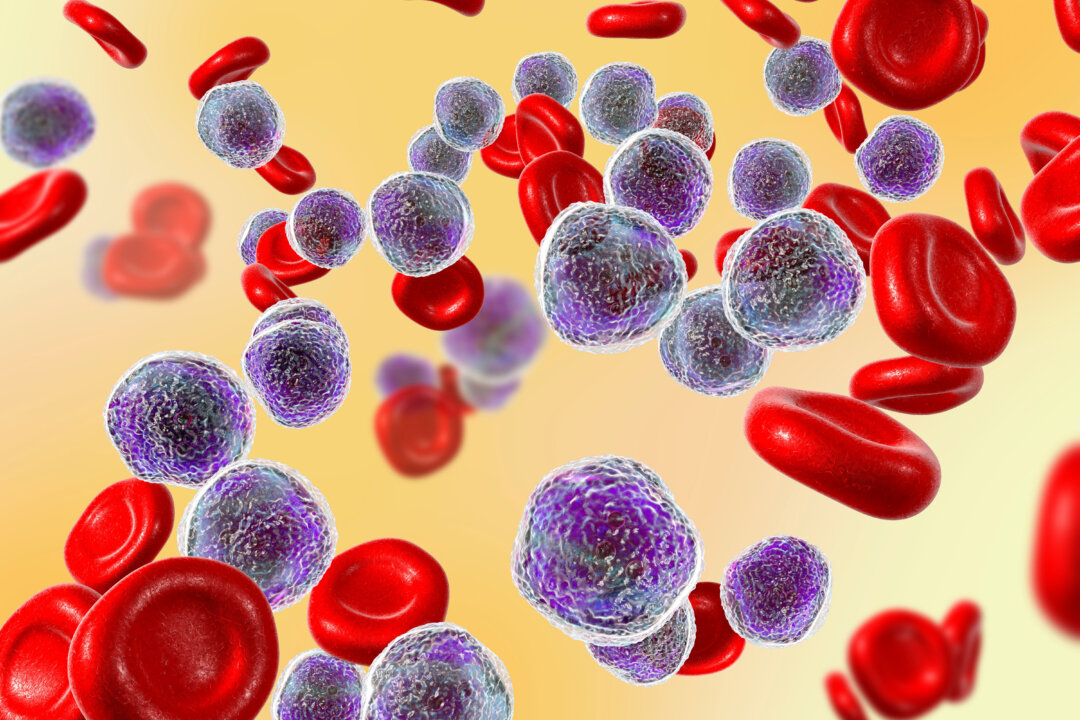 Acute lymphoblastic leukemia, bone marrow smear. (Kateryna Kon/Shutterstock)