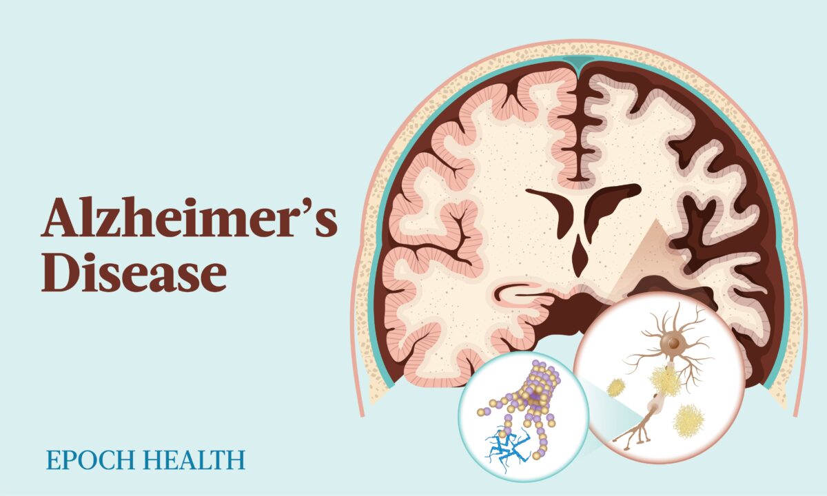 NextImg:The Essential Guide to Alzheimer's Disease: Symptoms, Causes, Treatments, and Natural Remedies