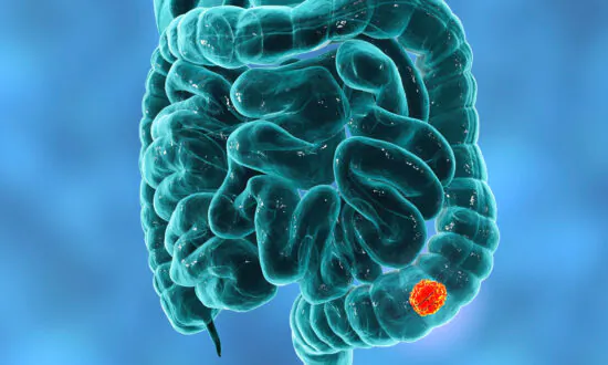 Know the Difference Between Hemorrhoids and Colorectal Cancer and When to Seek Help, Doctor Explains