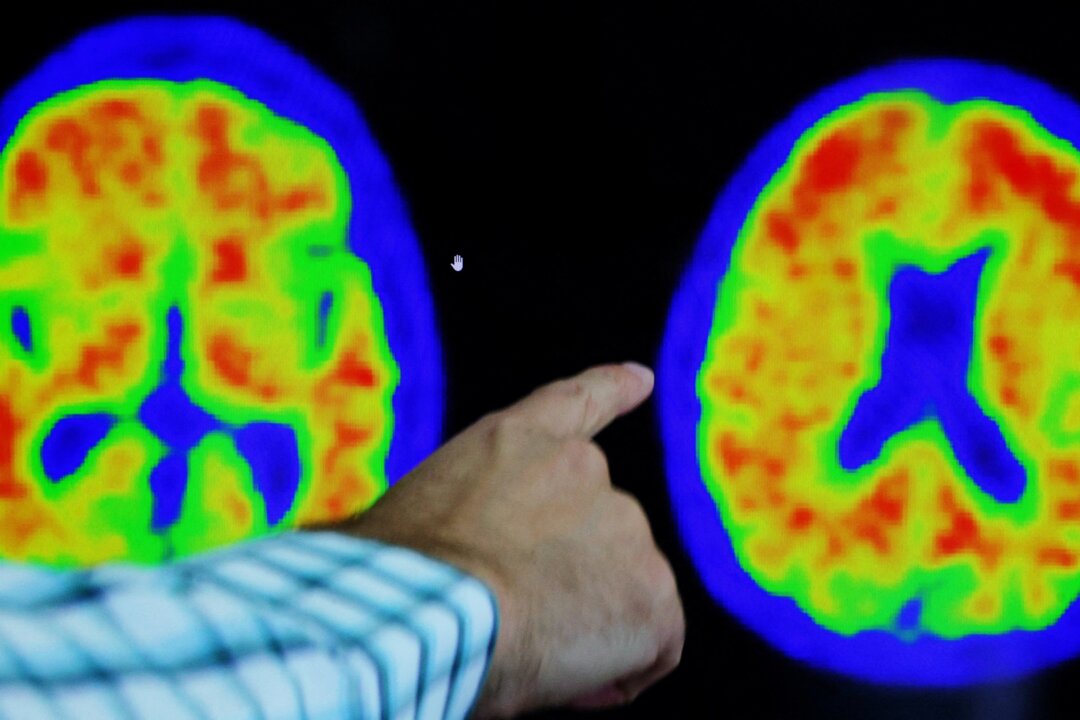 A doctor points out evidence of Alzheimer’s disease on PET scans at the Center for Alzheimer Research and Treatment (CART) at Brigham And Women’s Hospital in Boston on March 30, 2023. (Brian Snyder/Reuters)