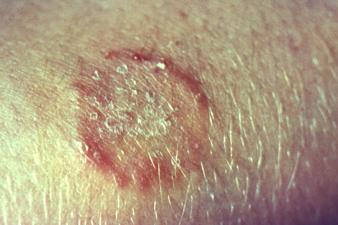File photo of a close view of a ringworm infection. (CDC/ Dr. Lucille K. Georg)