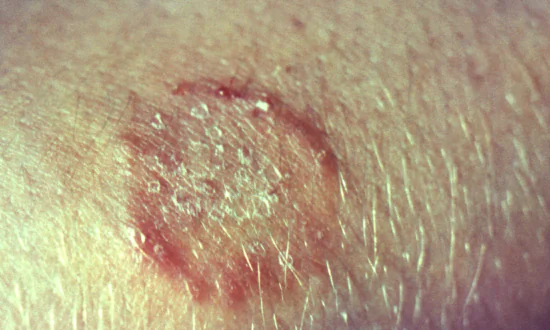 First Ever US Cases of Severe, Contagious, Drug-Resistant Ringworm Reported