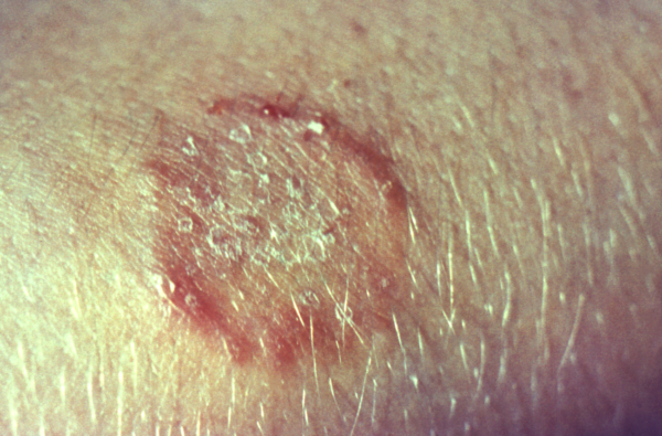 Experts Warn of New, Difficult-to-Treat Fungal Skin Infections Emerging in US