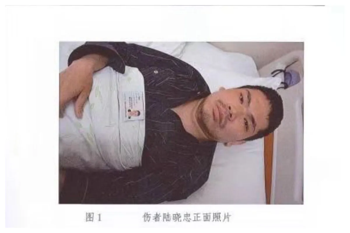  Lu Xiaozhong is pictured in an observing ward of Beijing Ditan Hospital on April 13, 2016, after he was injured by a thug from Shanghai Institute of Biological Products when he tried to file a complaint to Sinopharm petition office in Beijing about the tainted clotting factor VIII that caused various complications and generalized joint necrosis. (Courtesy of Lu Xiaozhong)