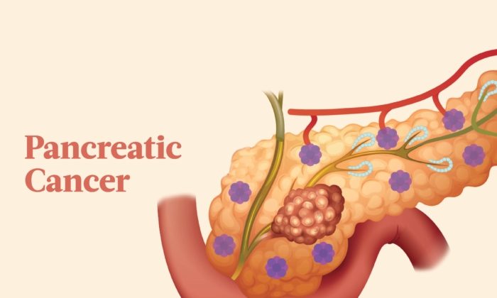 The Essential Guide to Pancreatic Cancer: Symptoms, Causes, Treatments ...