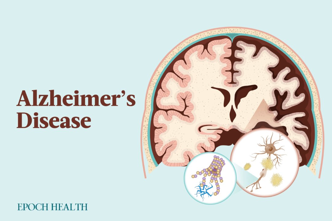 Alzheimer's disease is the seventh leading cause of death in the United States. (The Epoch Times)
