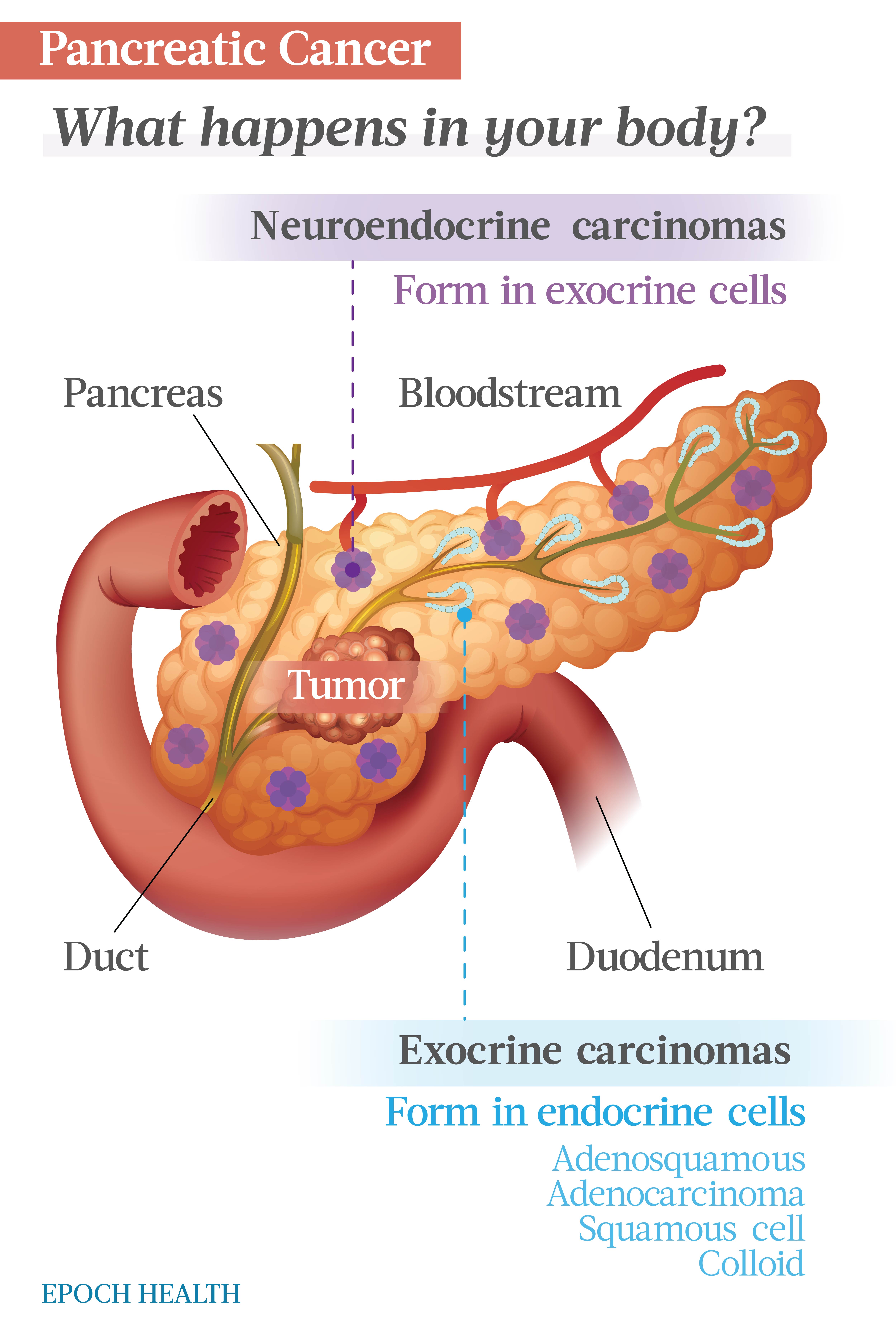 Pancreatic cancer either starts in endocrine or exocrine cells. The most common type is pancreatic adenocarcinoma. (The Epoch Times)