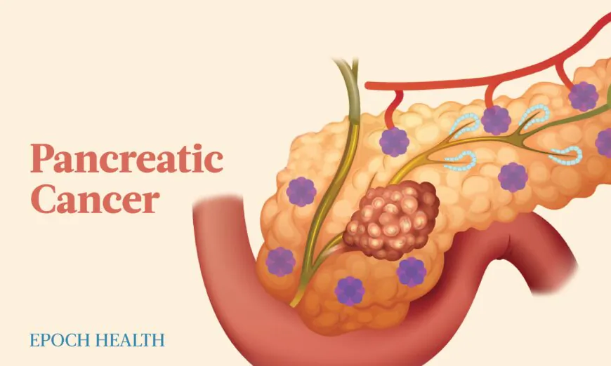 Il cancro al pancreas è una delle forme più impegnative di una malattia già difficile.  (The Epoch Times)
