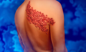 A Plethora of Skin Symptoms Reported After COVID Vaccination, Solution Exists