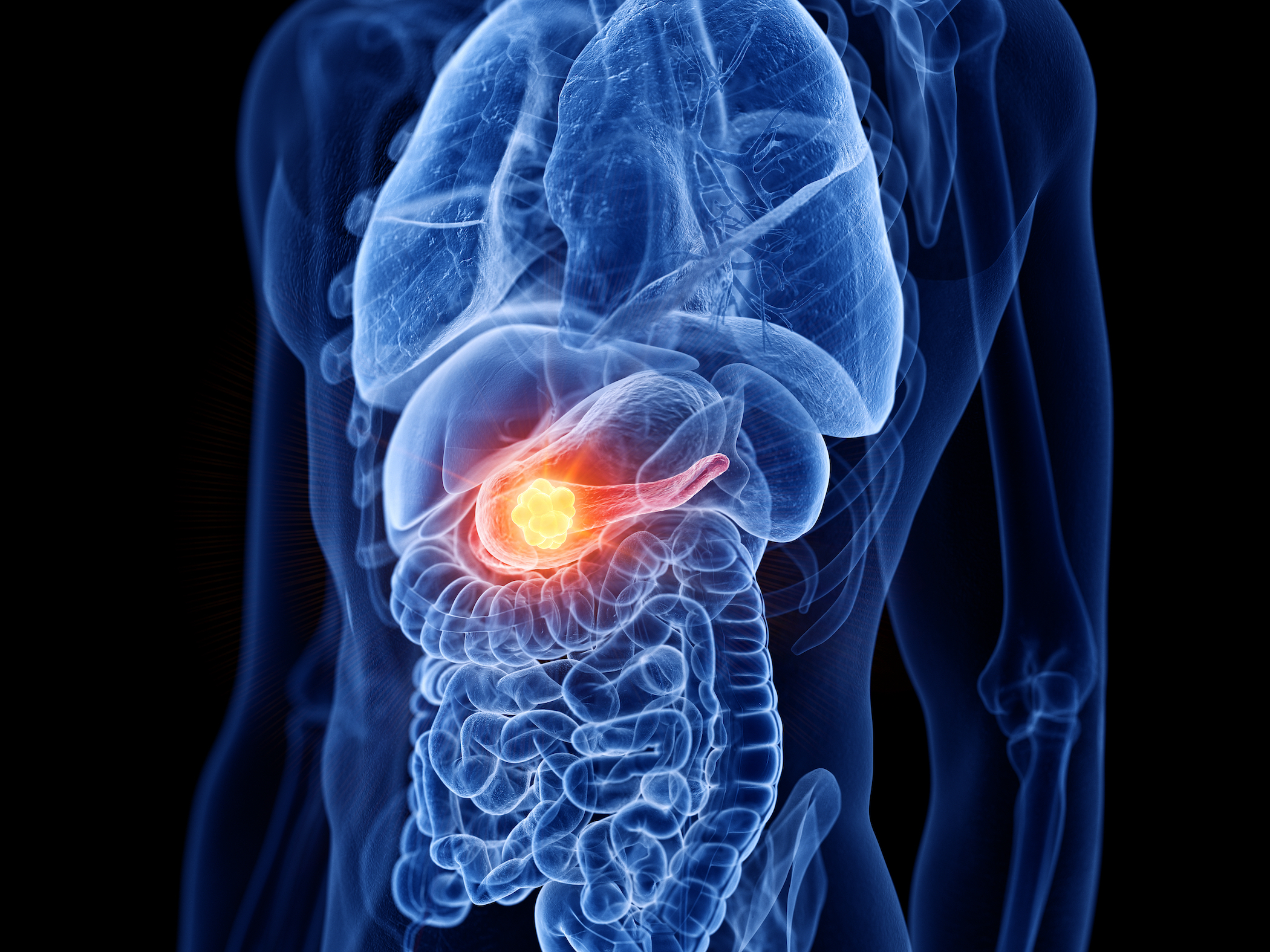 Pancreatic Cancer: One of the Deadliest Silent Cancers, With 12 Signs