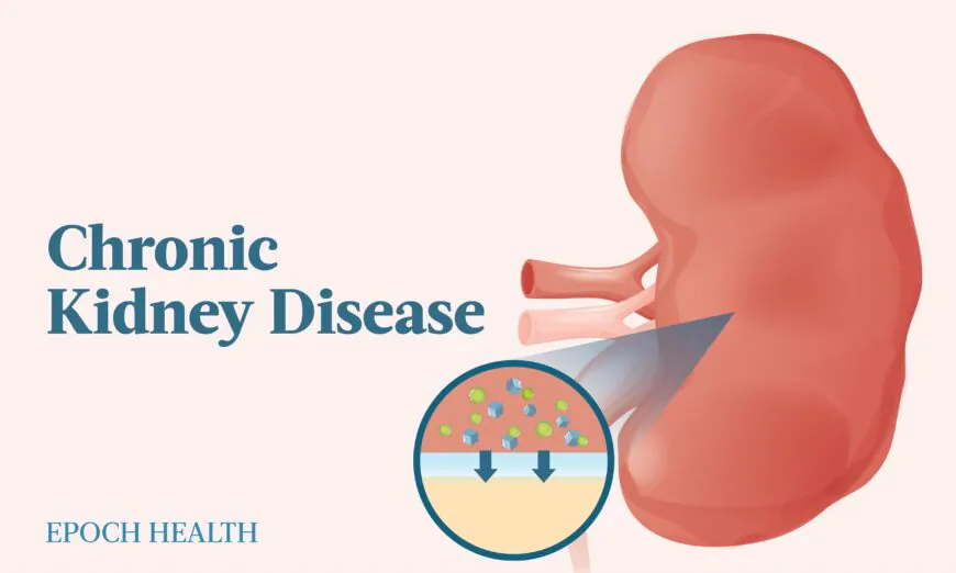 Chronic kidney disease has many causes, but fortunately, this means it is often a preventable disease. (The Epoch Times)