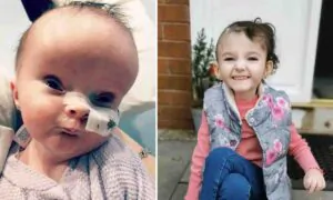 Baby Born With a Brain Condition That Made Her Look Like an Alien is Now 5 and Thriving