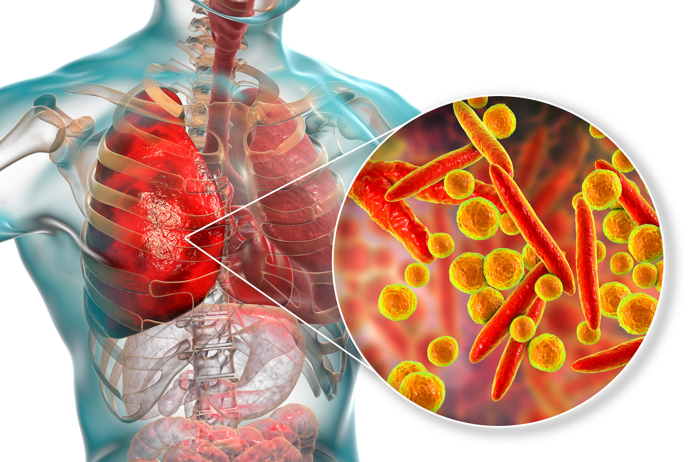 Majority of COVID Hospital Deaths Were Due to Untreated Bacterial Pneumonia - Vimarsana News