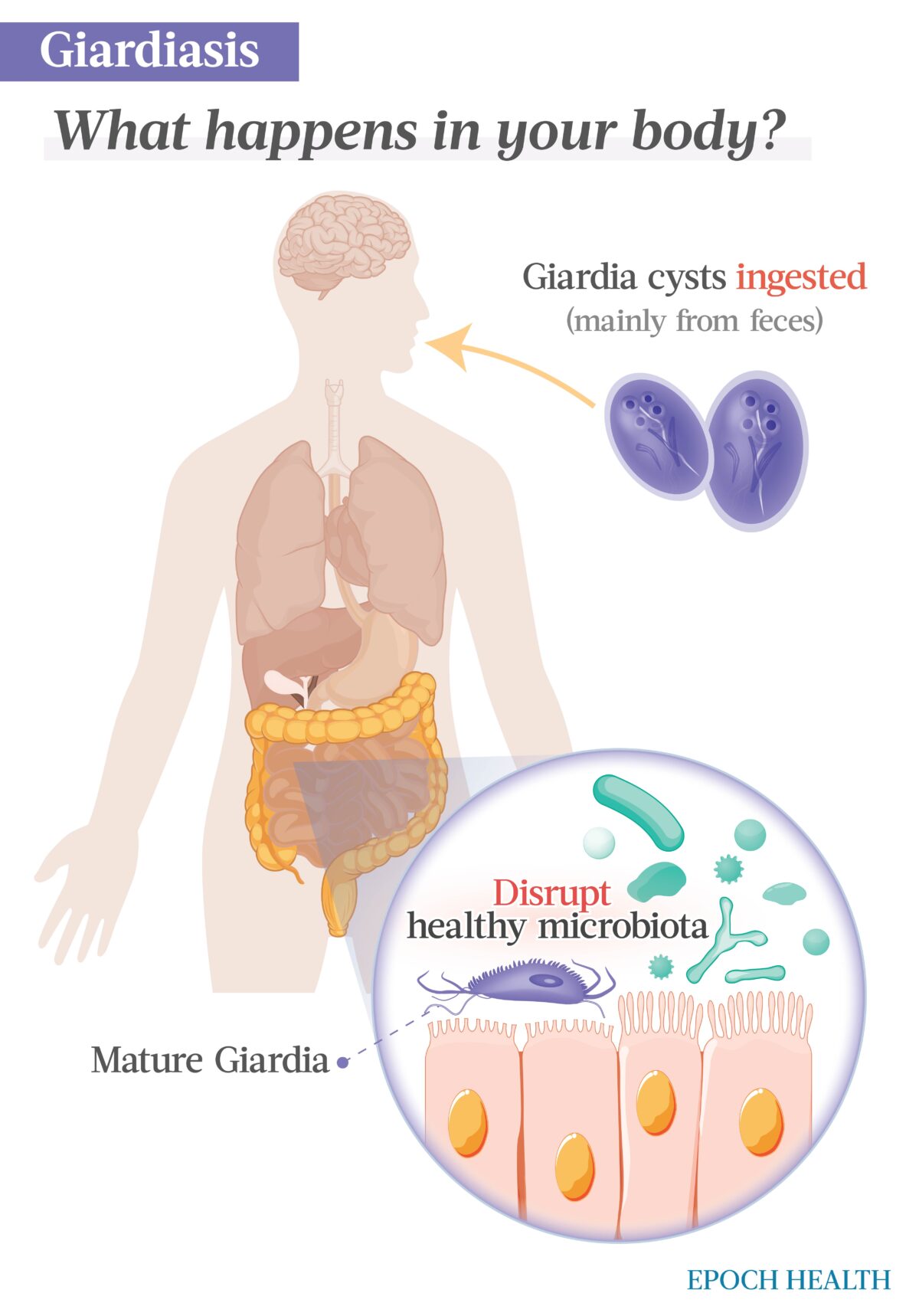 The Essential Guide To Giardiasis Symptoms Causes Treatments And Natural Approaches 4991