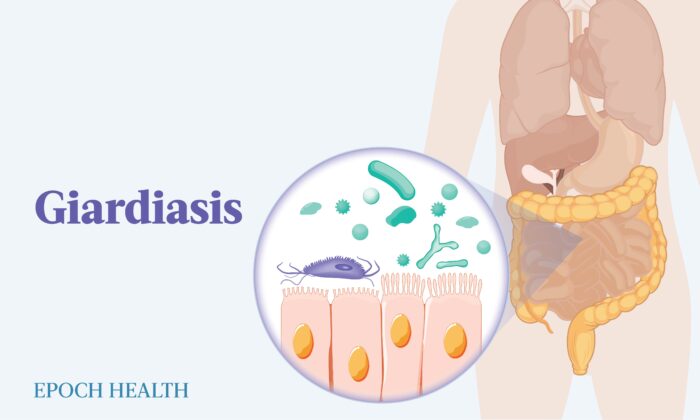 The Essential Guide to Giardiasis: Symptoms, Causes, Treatments, and Natural Approaches