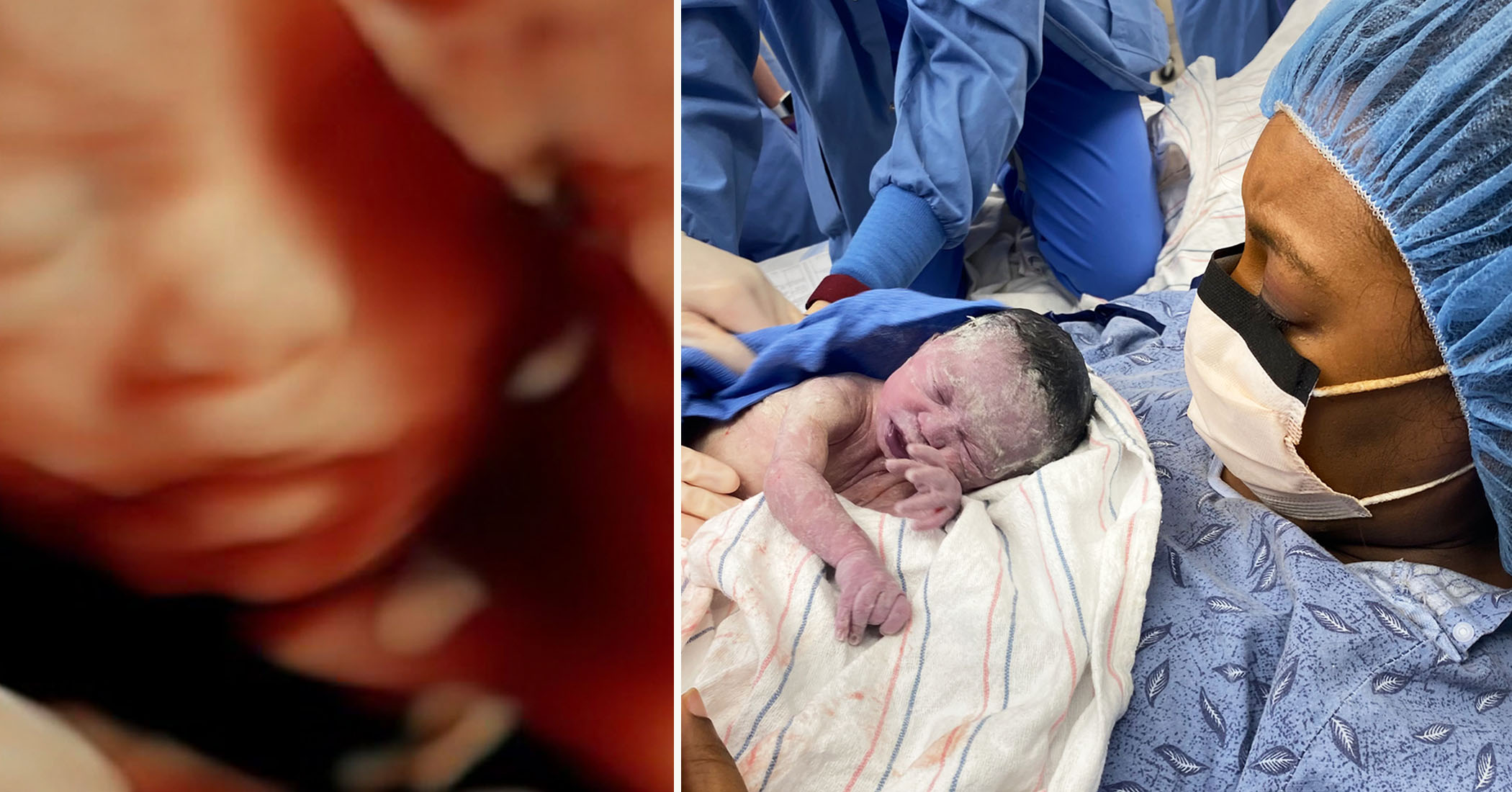 Baby in the womb undergoes first-of-its-kind surgery to place 23 coils in her brain, is now thriving