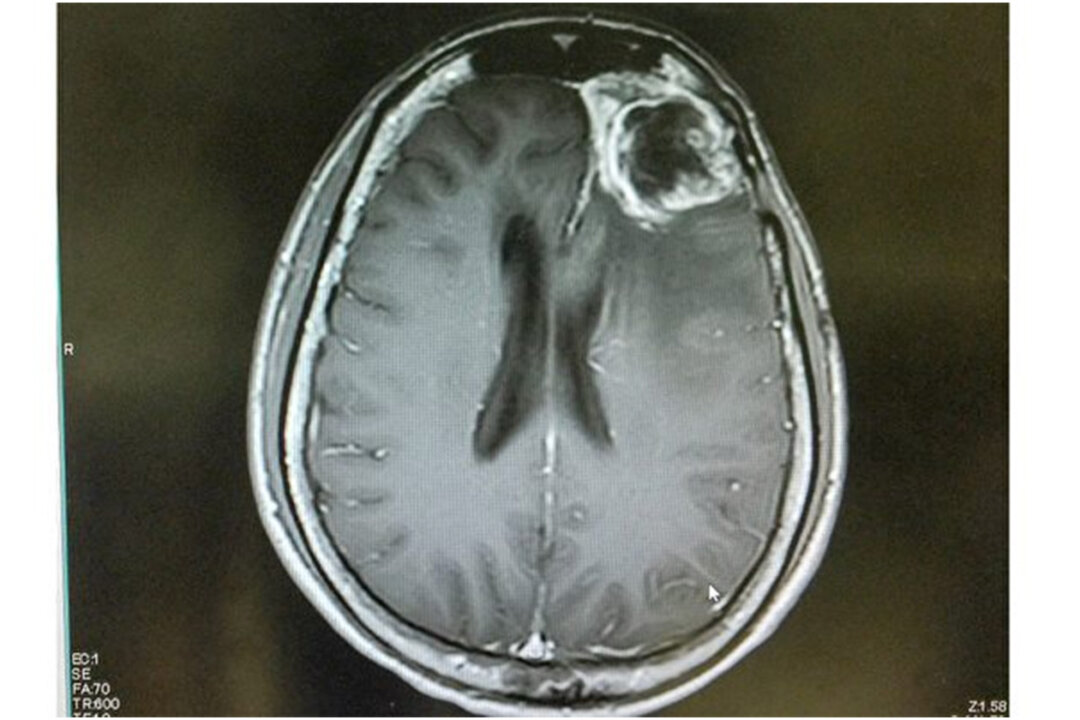 Magnetic resonance image of a glioblastoma. (ShutterStock）