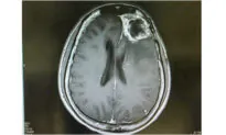 Ultrasound Therapy Helps Immune System Target Deadly Brain Cancer: NIH-Funded Study
